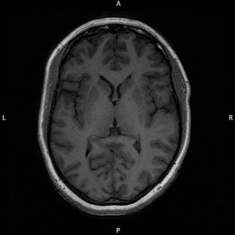 Brain MRI