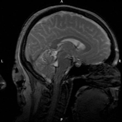 Brain MRI